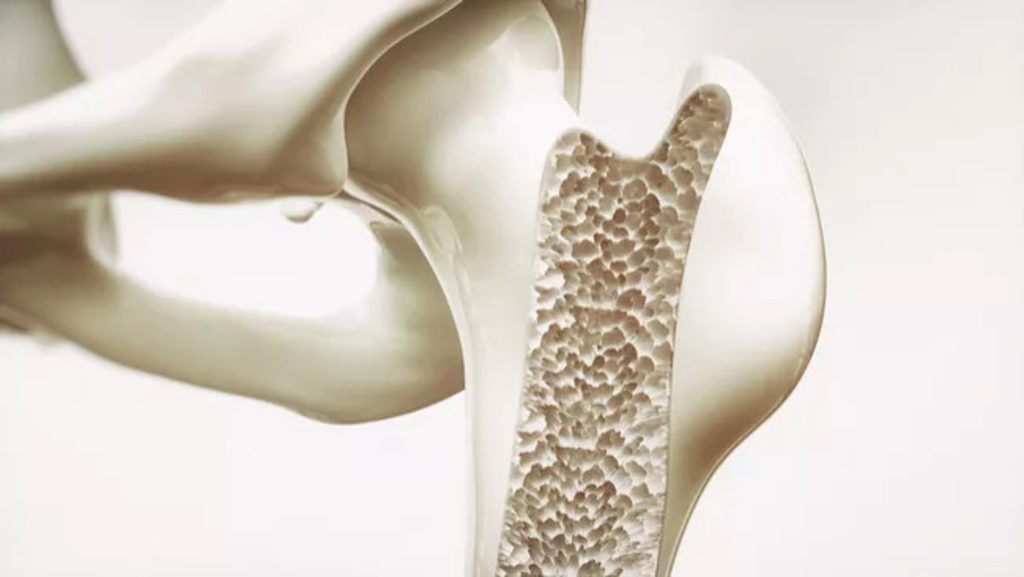 Jangan Asal Olahraga! Dokter Ungkap 5 Prinsip Penting untuk Mencegah Osteoporosis
